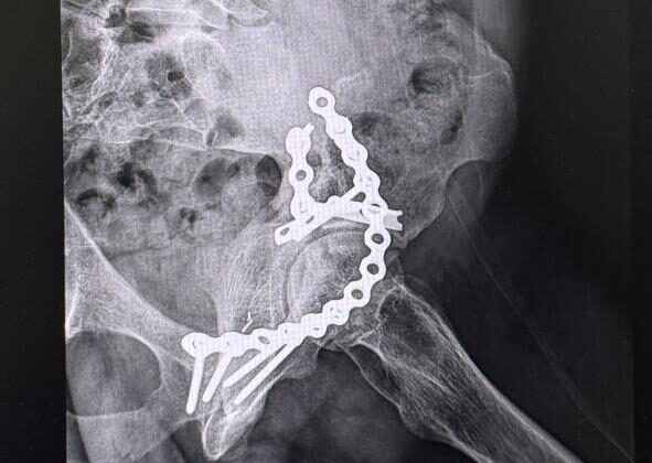 Radiografía de caso — Fractura de acetábulo