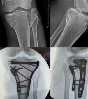 Radiografía de caso — Fractura de platillo tibial (meseta tibial)