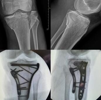 Radiografía de caso — Fractura de platillo tibial (meseta tibial)