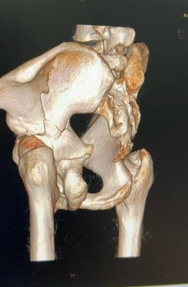 Radiografía de caso — Fractura de pelvis (anillo pélvico)
