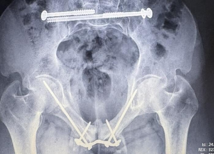 Caso de Fractura de pelvis (anillo pélvico) — Dr. Kushner