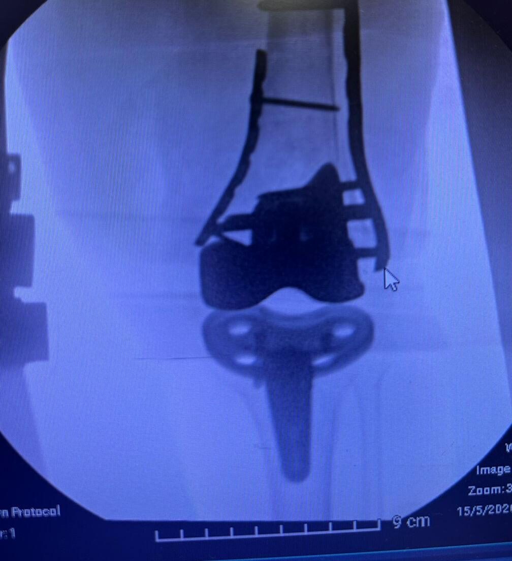 Radiografía de caso — Fracturas periprotésicas