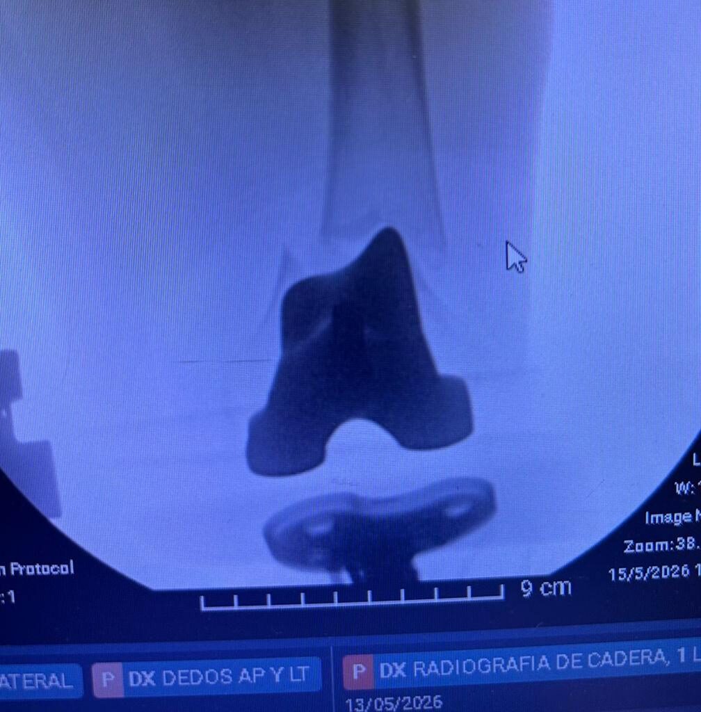 Caso de Fracturas periprotésicas — Dr. Kushner
