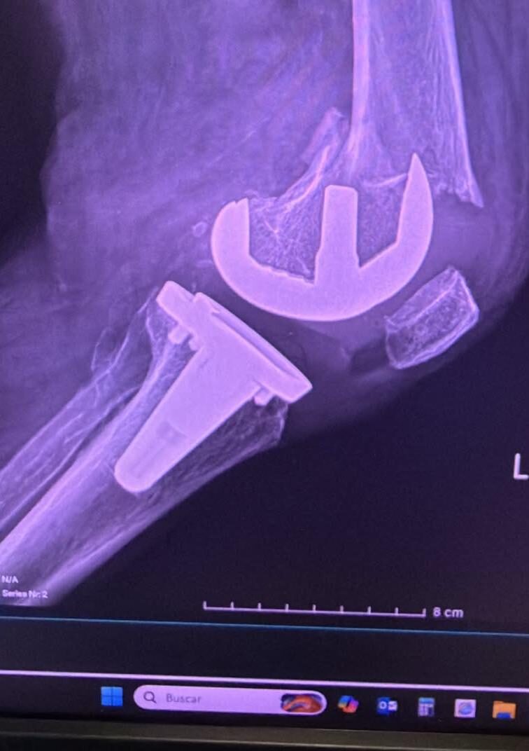 Radiografía de caso — Fracturas periprotésicas