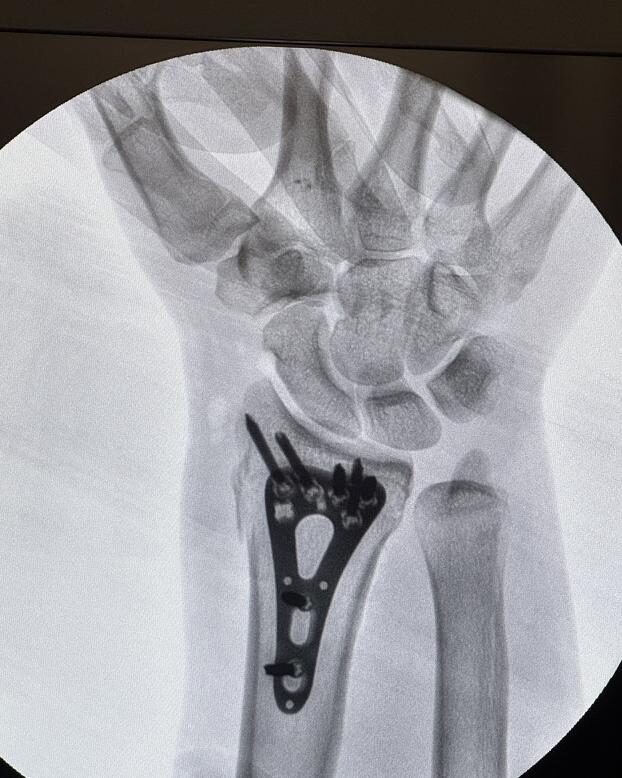 Caso de Fractura de radio distal (muñeca) — Dr. Kushner