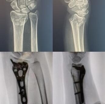 Radiografía de caso — Fractura de radio distal (muñeca)